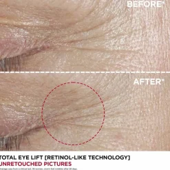 Total Eye Lift